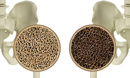 骨粗しょう症治療